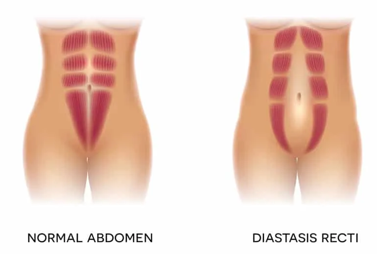 Recovering from Having Your Baby: Diastasis Recti